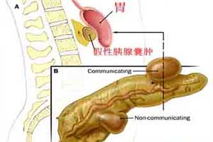 獲得性肝腦變性綜合症