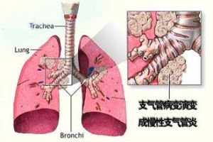 過敏性支氣管炎