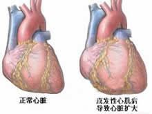 限制性心肌病