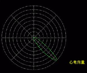 （圖）左束支中隔支傳導阻滯