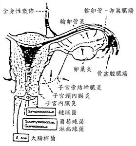 盆腔淤血綜合症