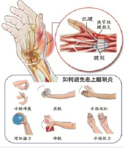 手指腱鞘炎