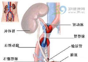 遺傳性進行性腎炎