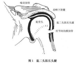 肱二頭肌長頭腱鞘炎