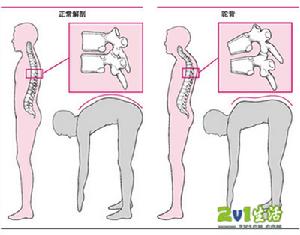 股骨頭骨軟骨炎