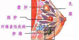 乳房腫瘤