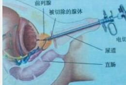 輸尿管取石術