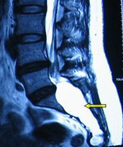 骶管囊腫