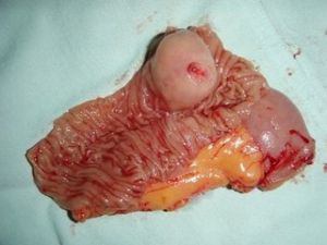 轉移性小腸腫瘤