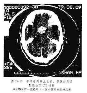 （圖）CT掃描