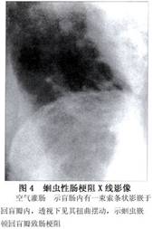 蛔蟲性腸梗阻