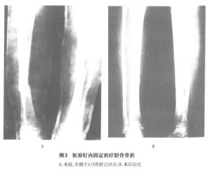 （圖）脛腓骨骨幹骨折