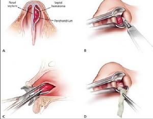 鼻中隔偏曲