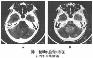 髓母細胞瘤