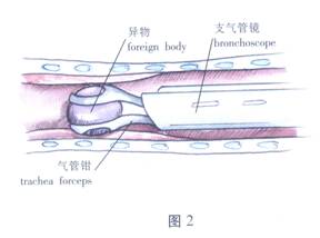 氣管、支氣管異物