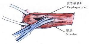 異物性食管穿孔
