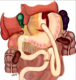 胃旁路手術