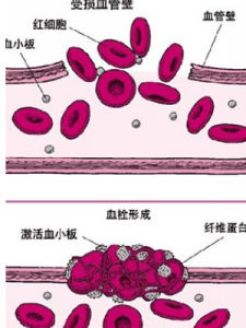 血小板增多症