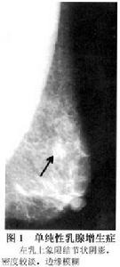 單純性乳腺增生症 圖1