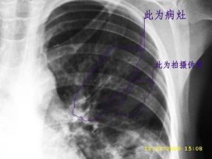 肺支原體肺炎