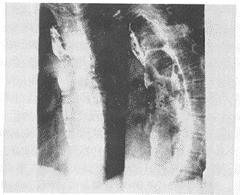 食管瘢痕性狹窄食管鋇餐造影X線