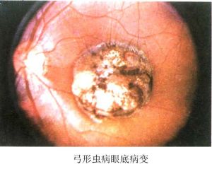 脈絡膜新生血管