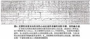 雙向性室性心動過速