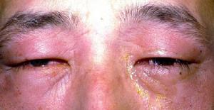 眼瞼痙攣-口下頦部肌張力障礙