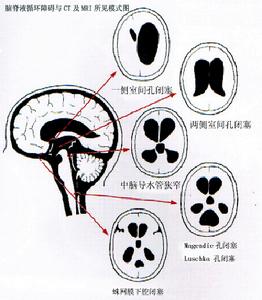 （圖）腦脊液