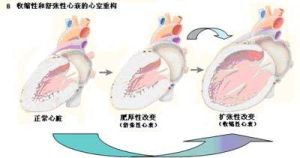 心室重構