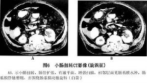 小腸扭轉