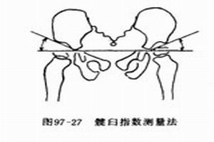 多骨纖維發育不良