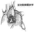 主動脈瓣膜部狹窄