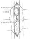 硬脊膜外膿腫手術