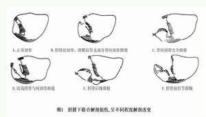 脛腓下聯合前部分離病因