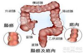 結腸癌轉移