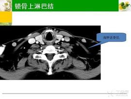 鎖骨上淋巴結