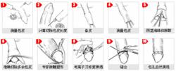 包皮環切術手術步驟示意圖2