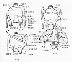 完全性肺靜脈異位回流