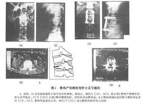 椎體嚴重楔形變並伴小關節半脫位