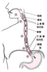 巴雷特氏食管