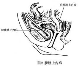 膀胱上內疝