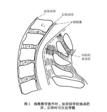 頸椎椎管狹窄