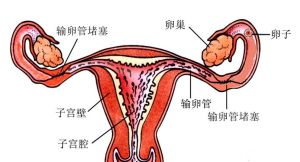 輸卵管堵塞