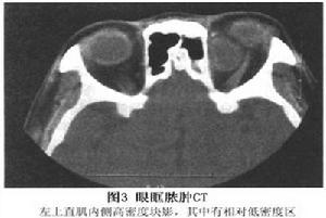 眼眶膿腫