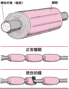 神經軸索損傷