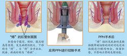 PPH治療示意圖