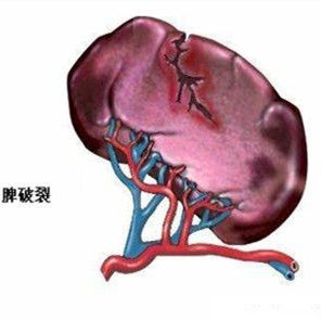 突發性血小板減少