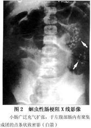 蛔蟲性腸梗阻