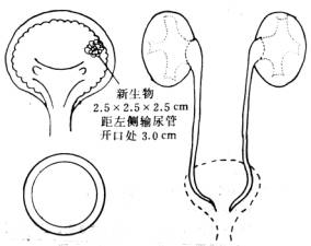 膀胱輸尿管返流